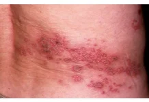 Cacar Api Bisa Menyiksa Bertahun, Sakitnya Lebihi Operasi